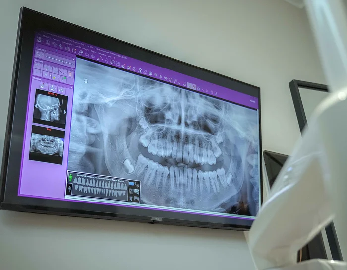 Radiografia panoramica dei denti - Prenota una visita ortodontica a Torino